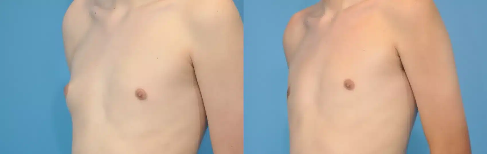 Before and After Image: Case #130 - left-front-oblique