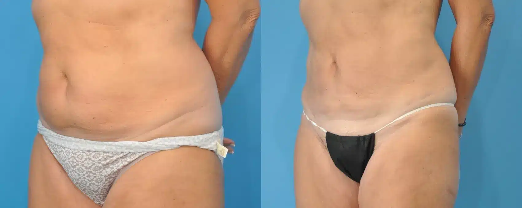 Before and After Image: Case #133 - left-front-oblique