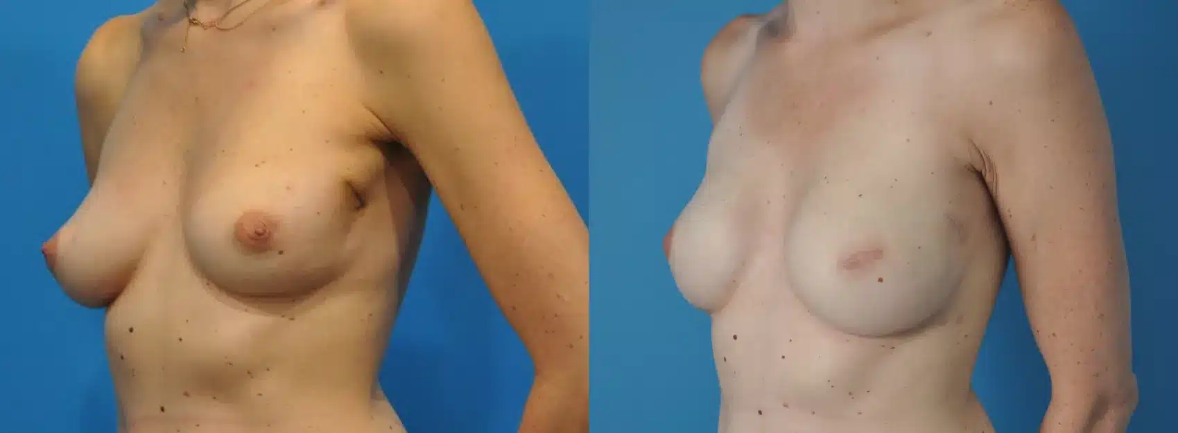 Before and After Image: Case #134 - left-front-oblique