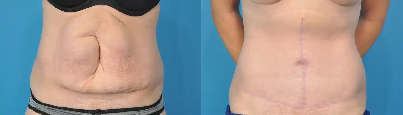 Before and After Image: Case #136 - front
