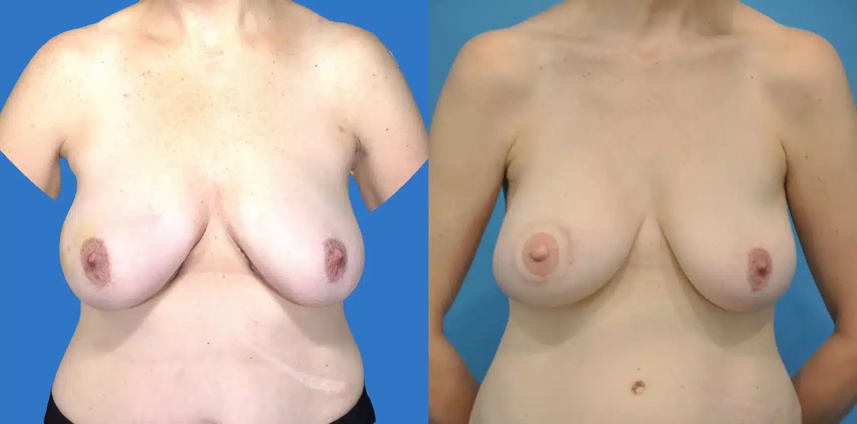 Before and After Image: Case #14 - front