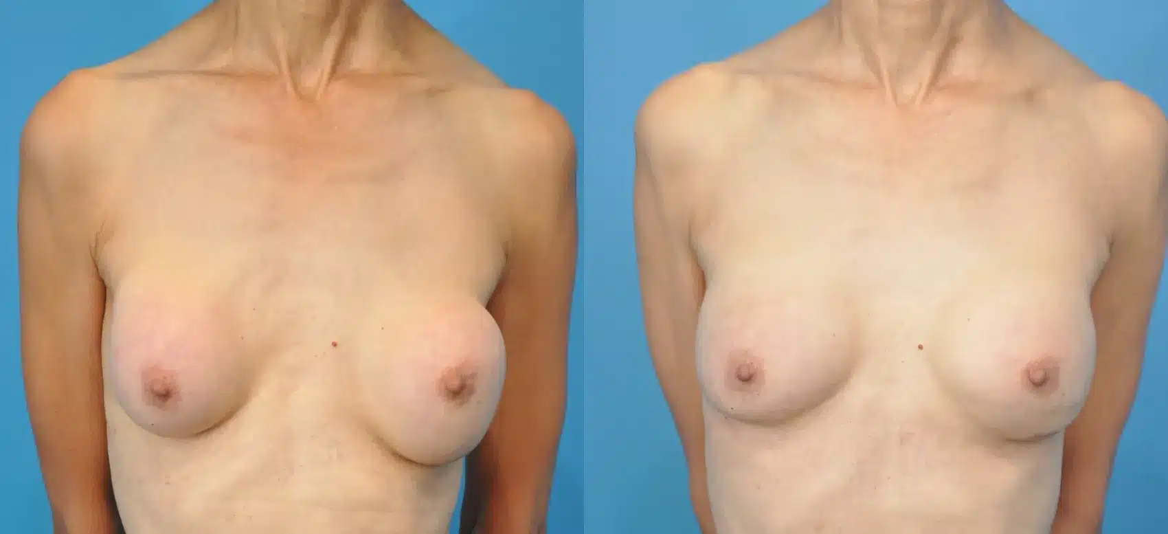 Before and After Image: Revision Breast Augmentation - front