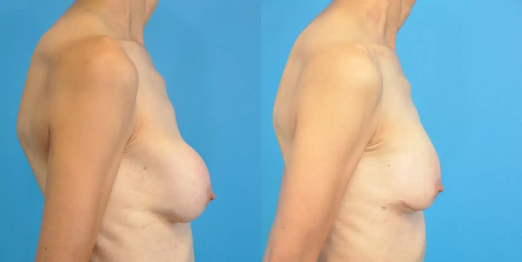 Before and After Image: Revision Breast Augmentation - right-side