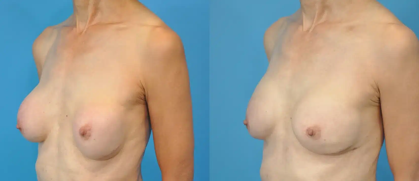 Before and After Image: Revision Breast Augmentation - left-front-oblique