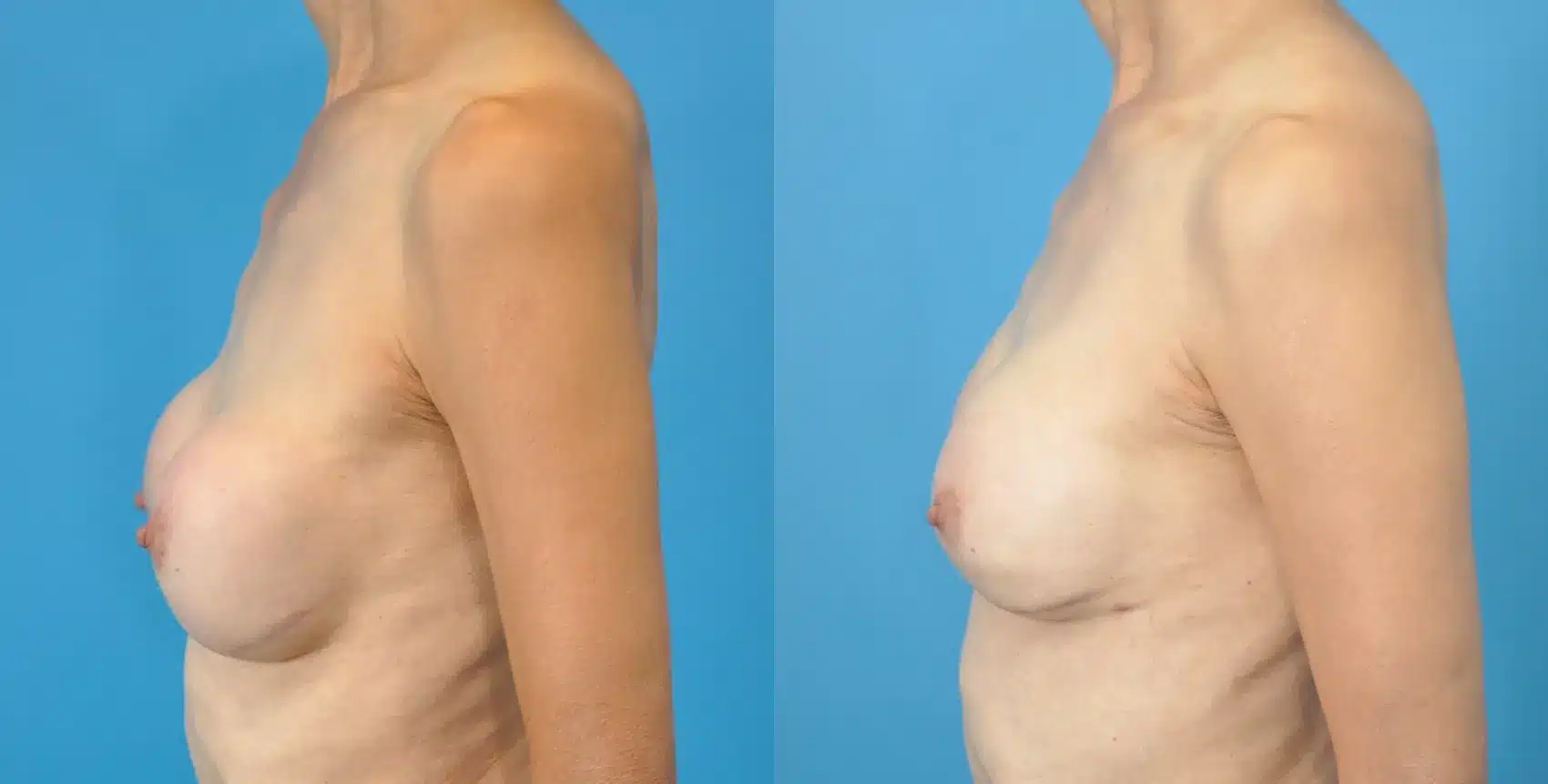 Before and After Image: Revision Breast Augmentation - left-side