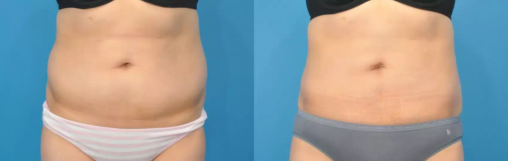 Before and After Image: Case #141 - front