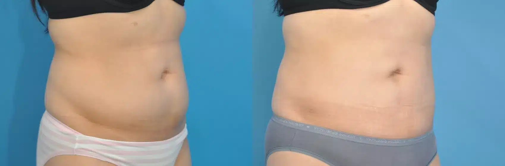 Before and After Image: Case #141 - right-front-oblique