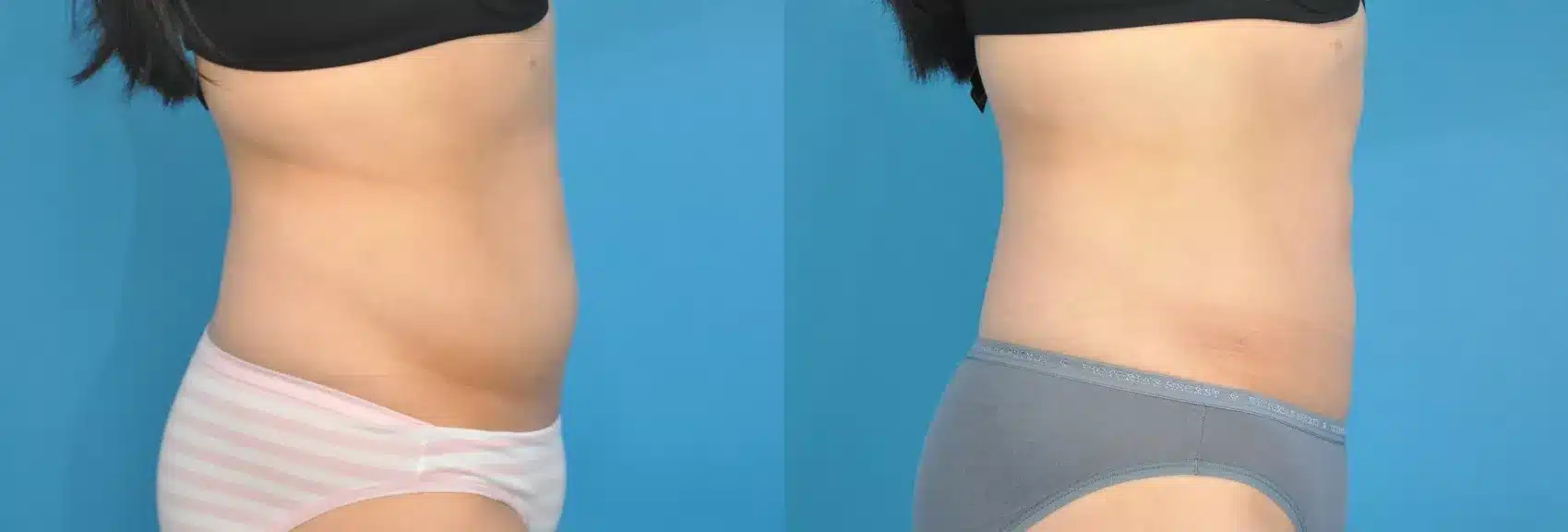 Before and After Image: Case #141 - right-side