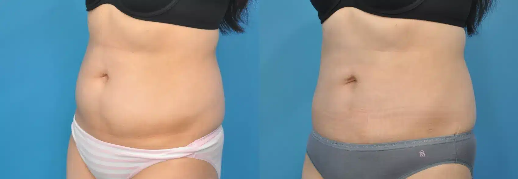 Before and After Image: Case #141 - left-front-oblique