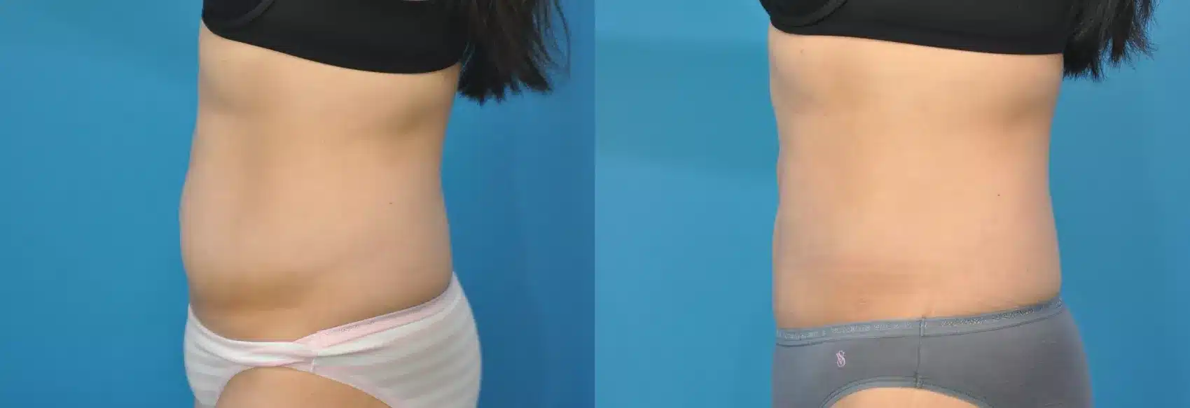 Before and After Image: Case #141 - left-side
