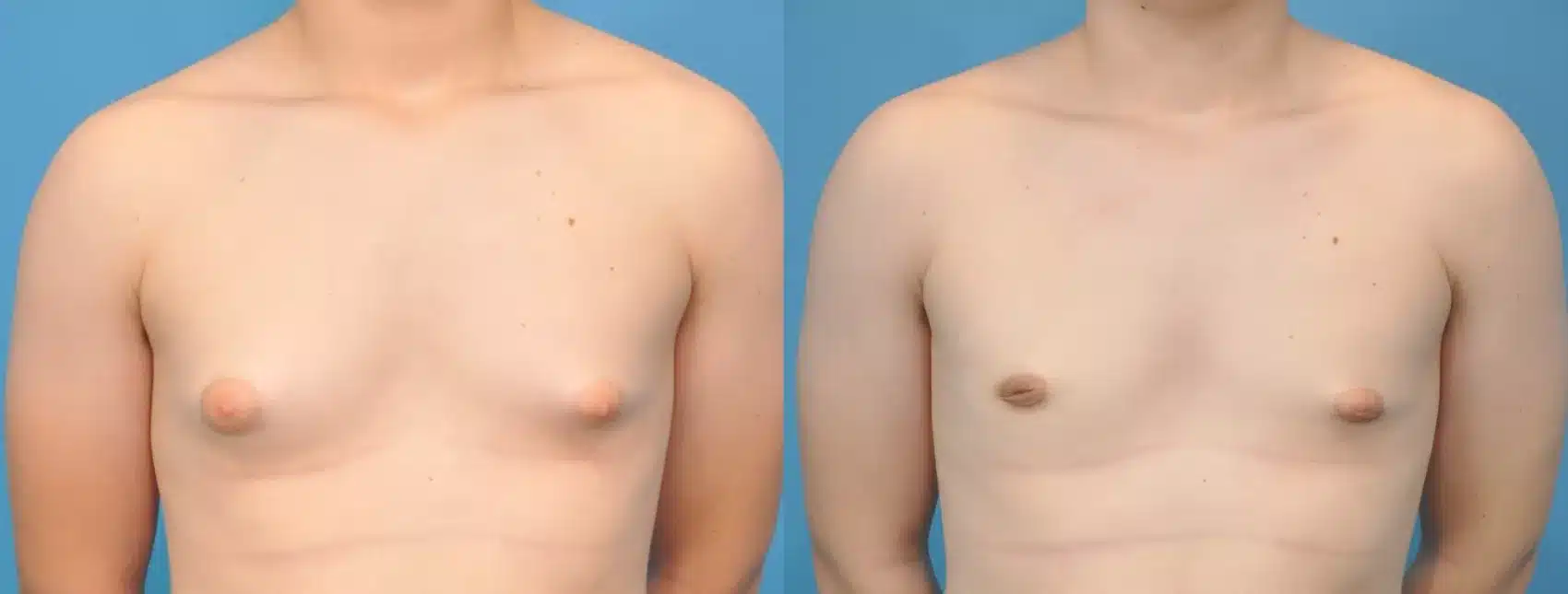 Before and After Image: Case #142 - front