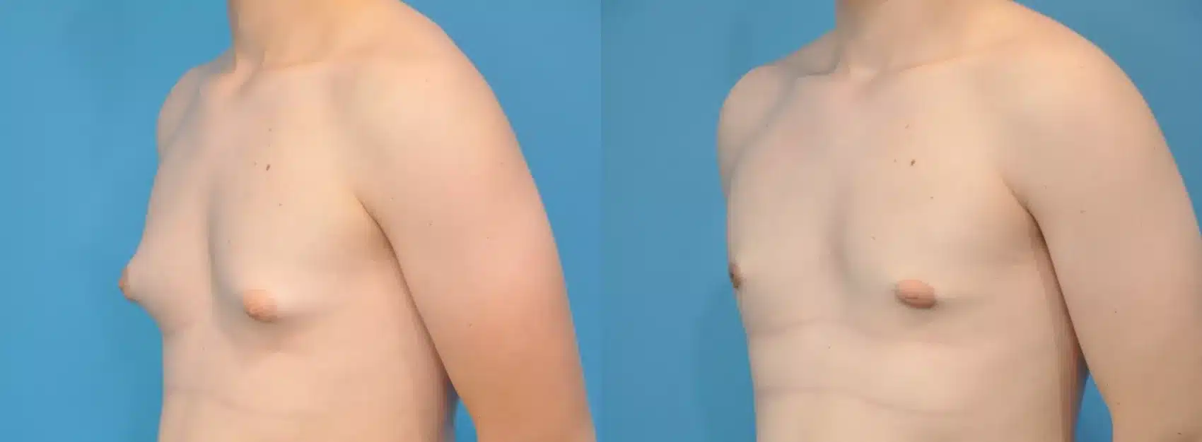 Before and After Image: Case #142 - left-front-oblique