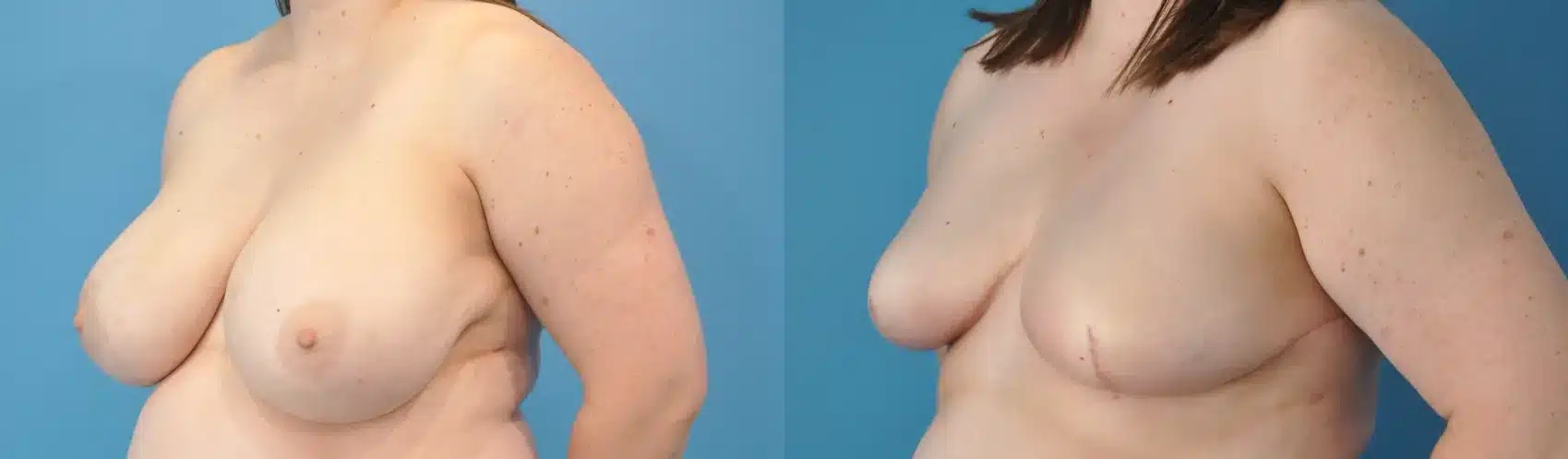 Before and After Image: Breast Reconstruction with Implants - left-front-oblique