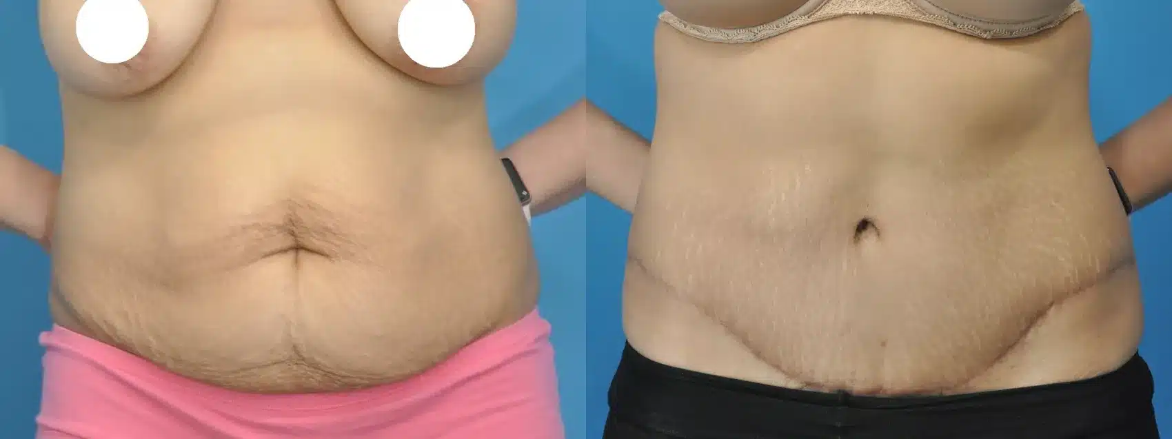 Before and After Image: Tummy Tuck - front