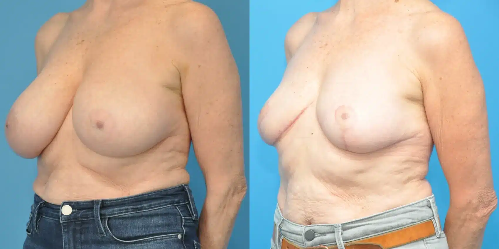 Before and After Image: Breast Reduction and Lift - left-front-oblique