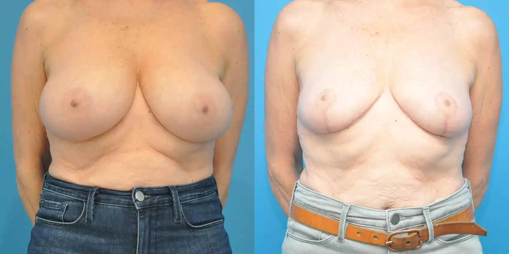 Before and After Image: Breast Reduction and Lift - front