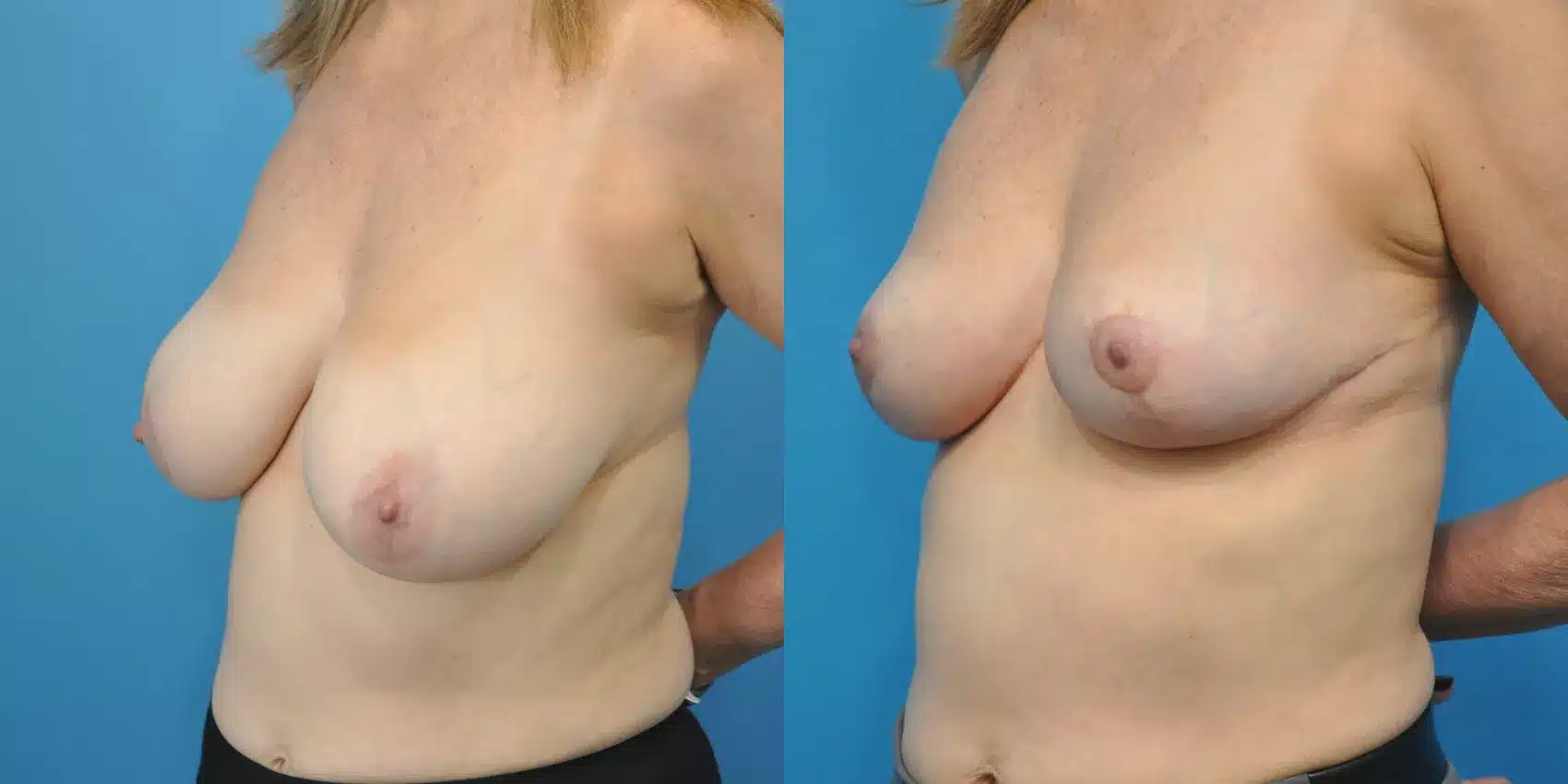 Before and After Image: Case #149 - left-front-oblique