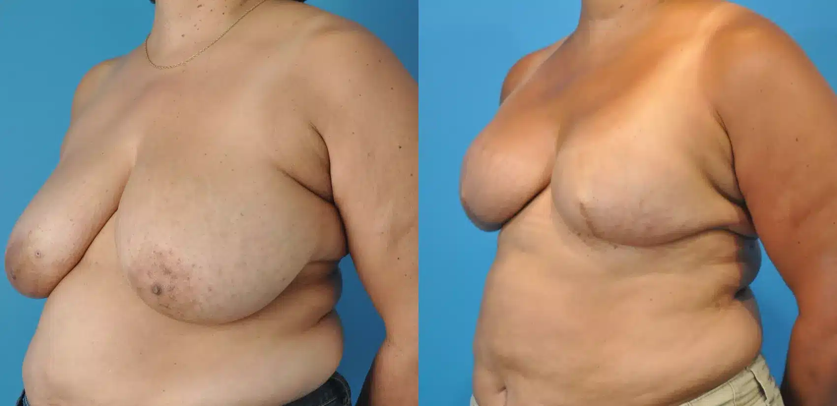 Before and After Image: Case #15 - left-front-oblique