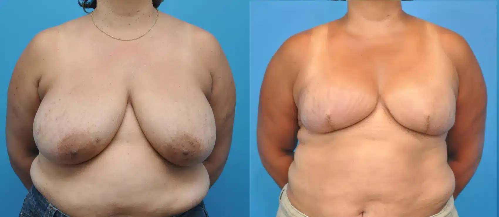 Before and After Image: Case #15 - front