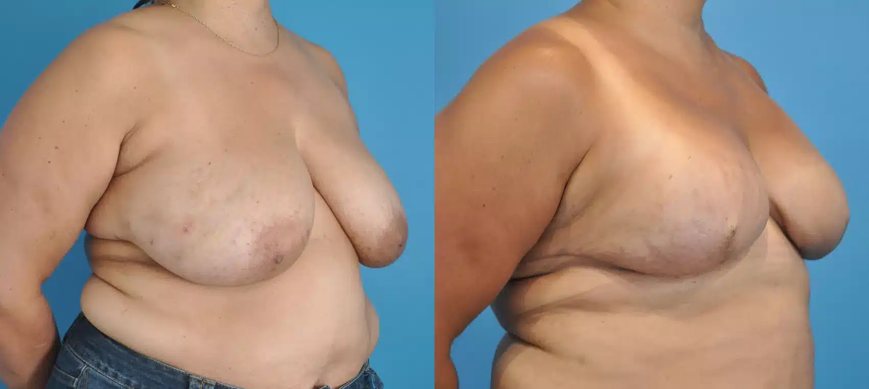 Before and After Image: Case #15 - right-front-oblique