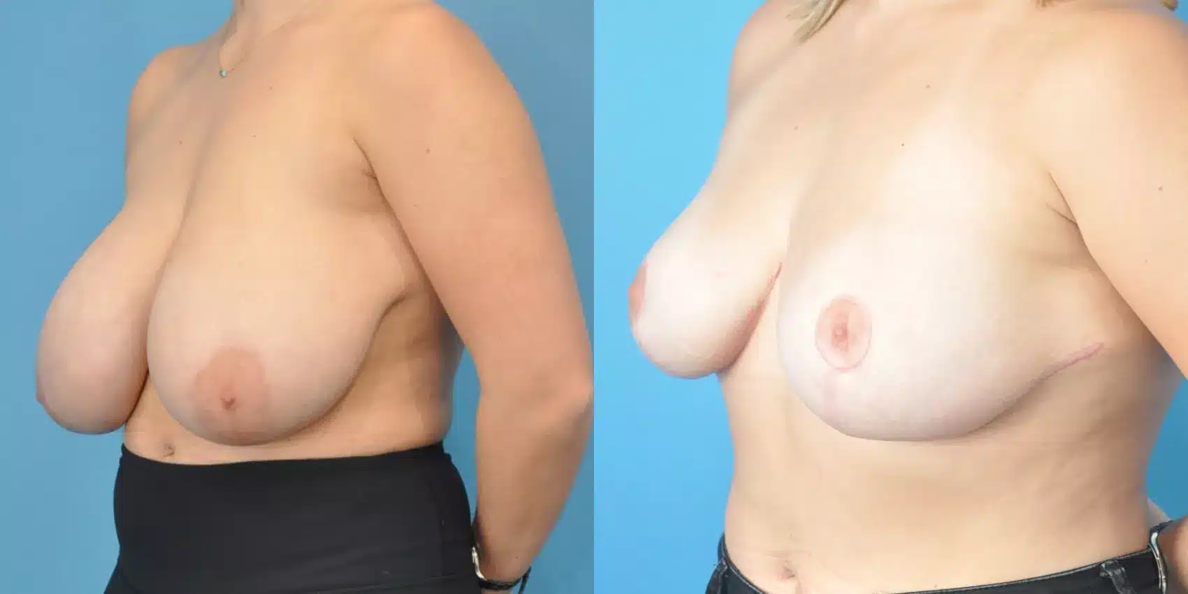 Before and After Image: Case #150 - left-front-oblique