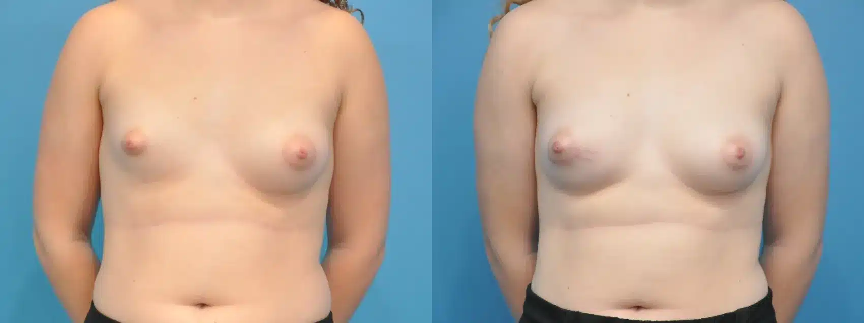 Before and After Image: One-Sided Breast Augmentation 175 ml Saline - front