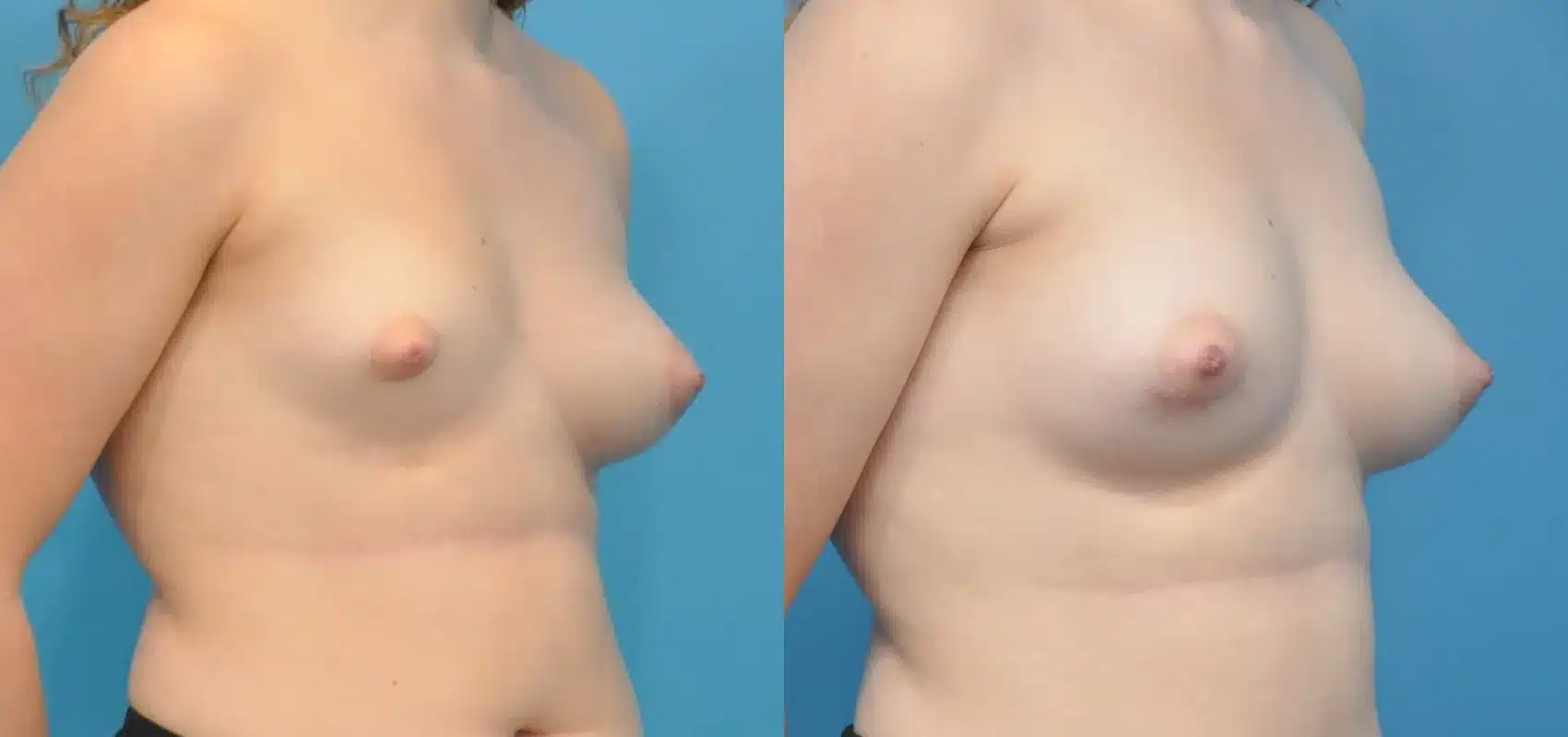 Before and After Image: One-Sided Breast Augmentation 175 ml Saline - right-front-oblique