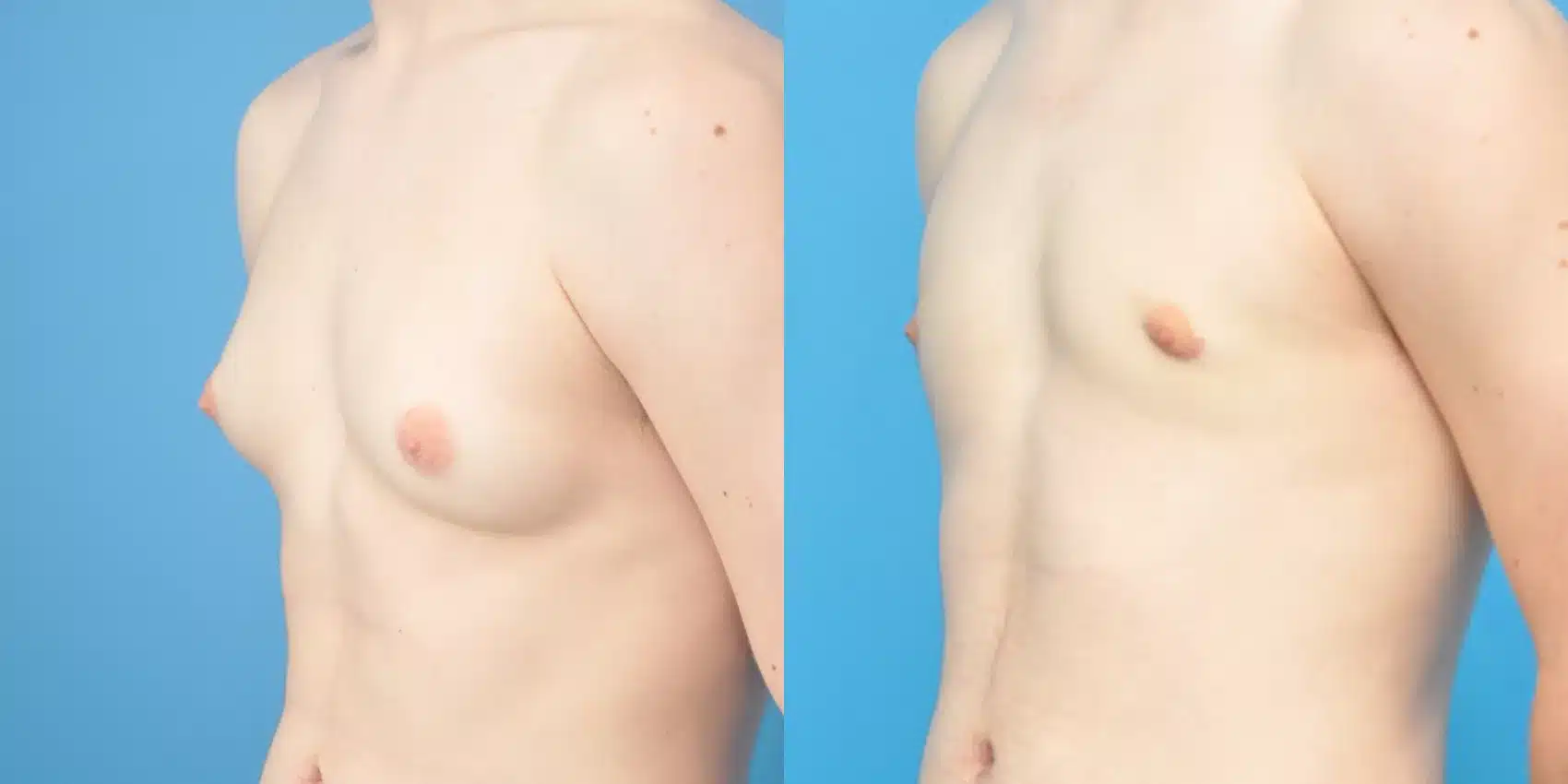 Before and After Image: Case #153 - left-front-oblique
