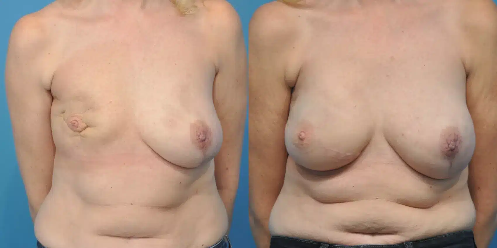 Before and After Image: Case #154 - front