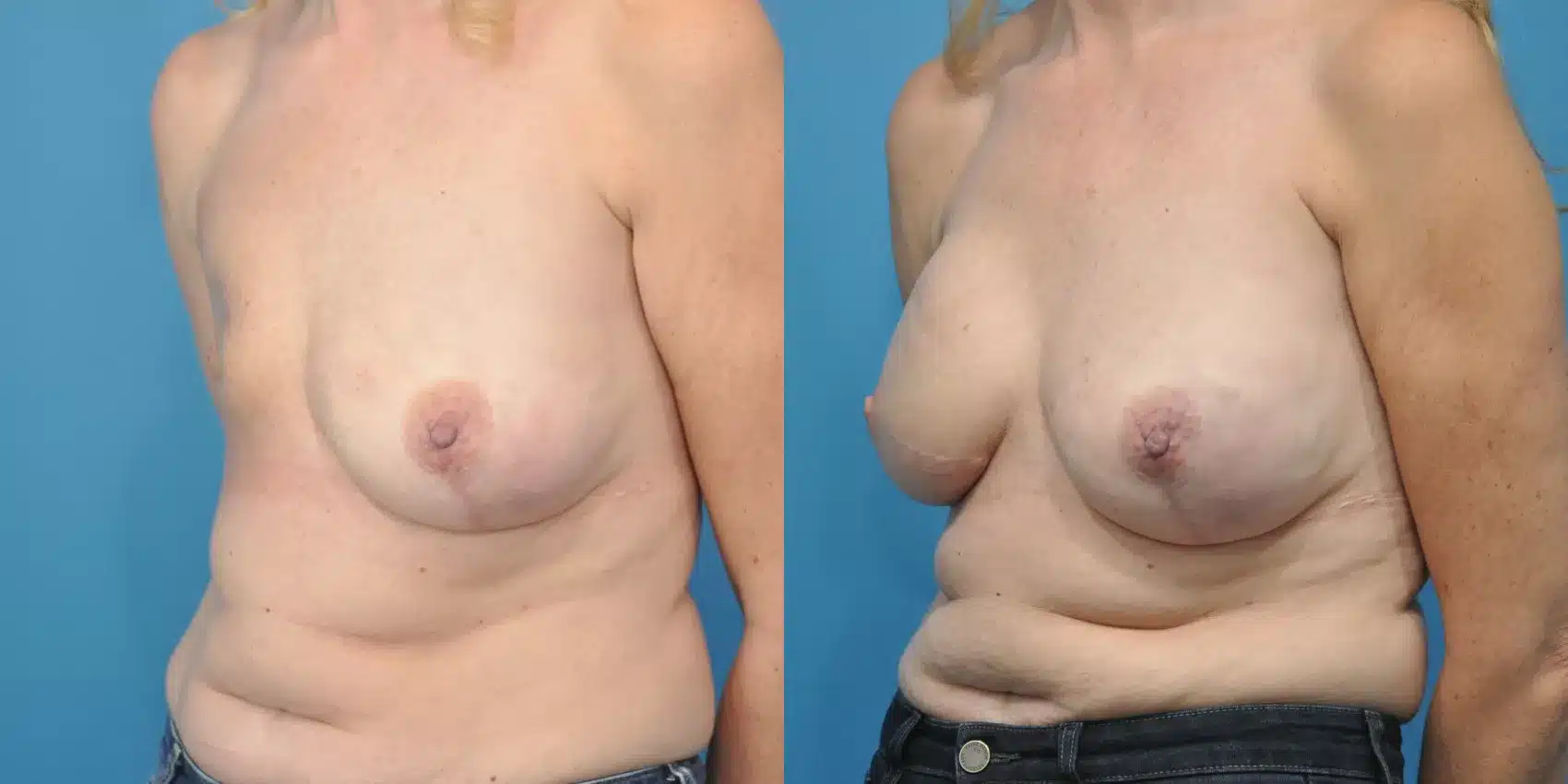 Before and After Image: Case #154 - left-front-oblique