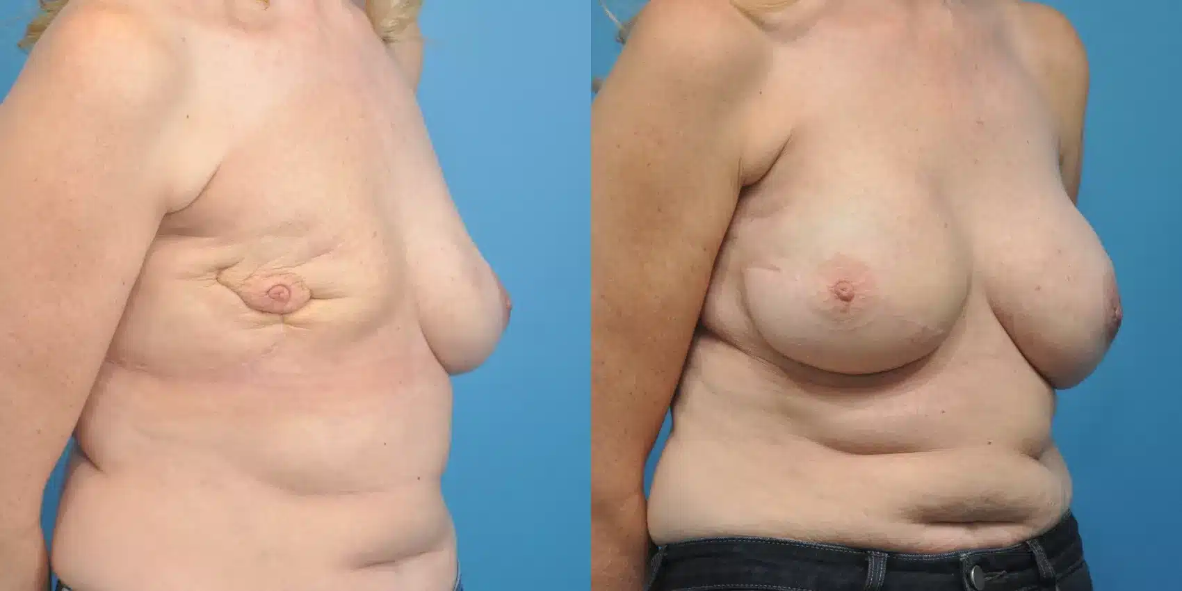 Before and After Image: Case #154 - right-front-oblique