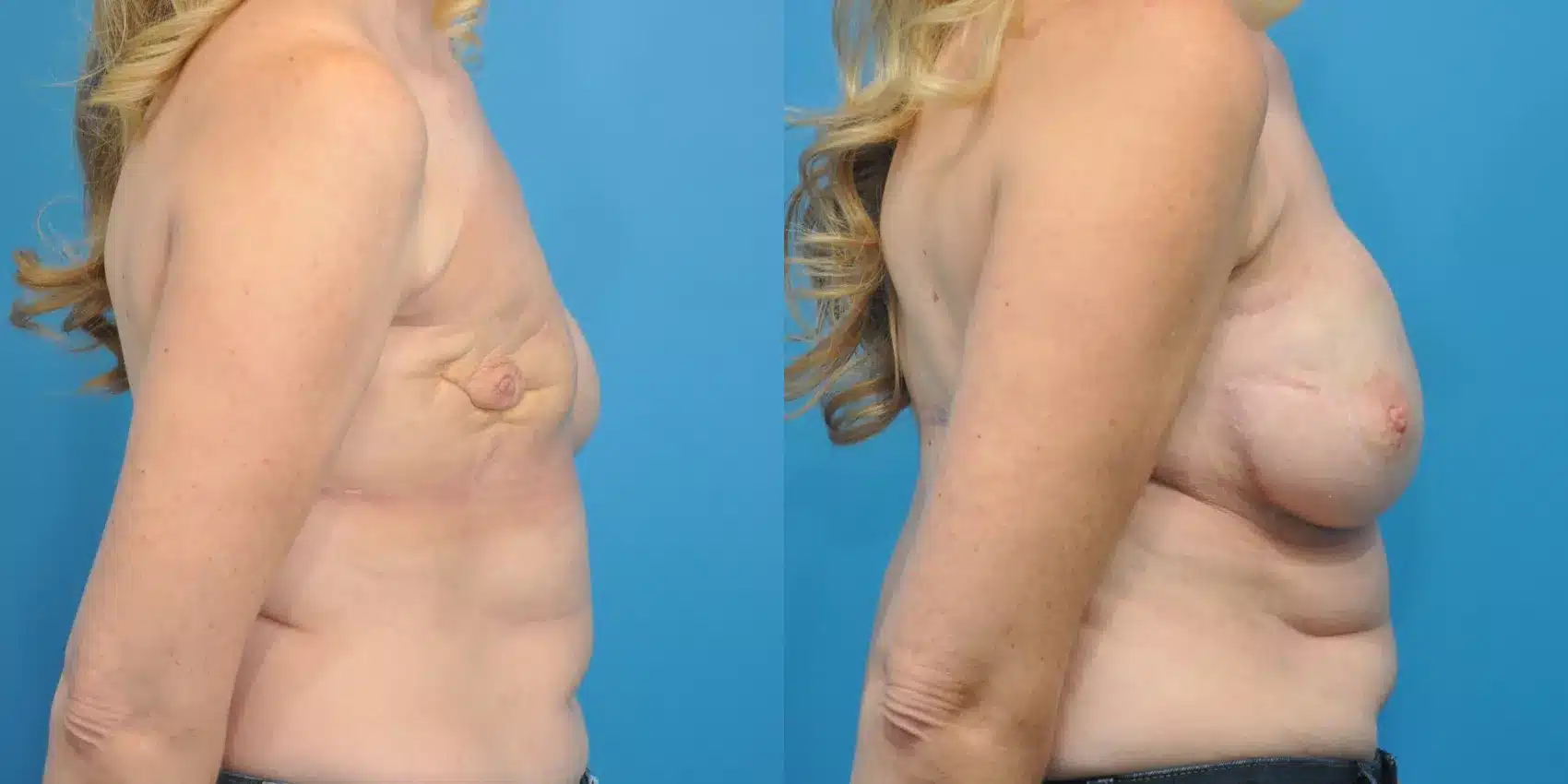 Before and After Image: Case #154 - right-side