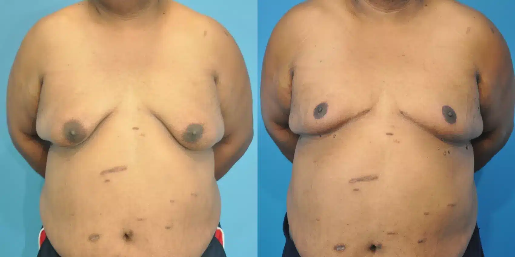 Before and After Image: Case #155 - front