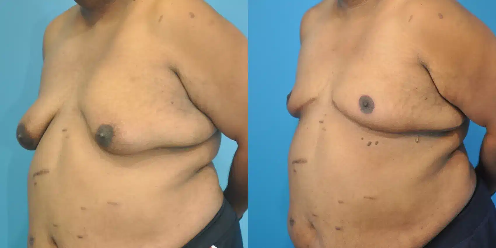 Before and After Image: Case #155 - left-front-oblique