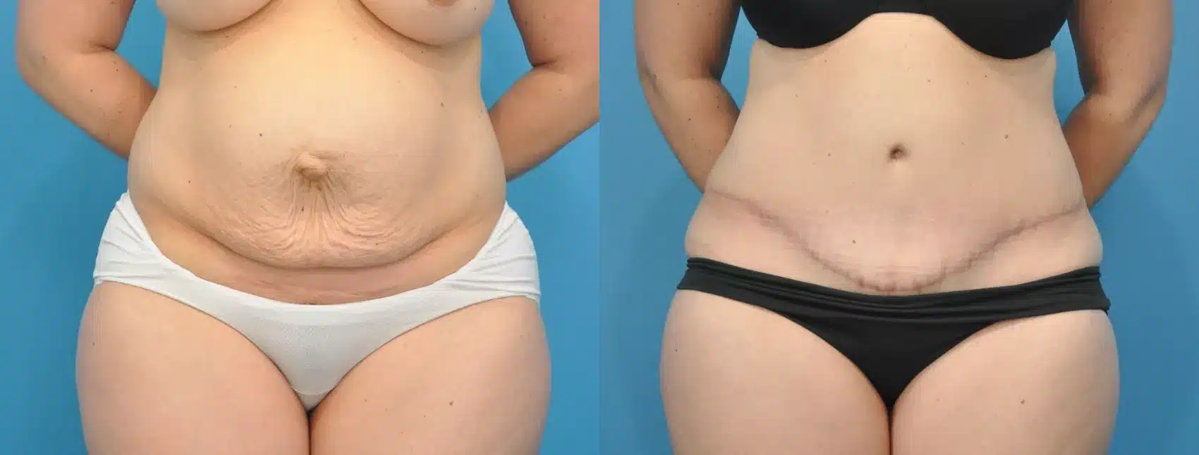 Before and After Image: Case #156 - front