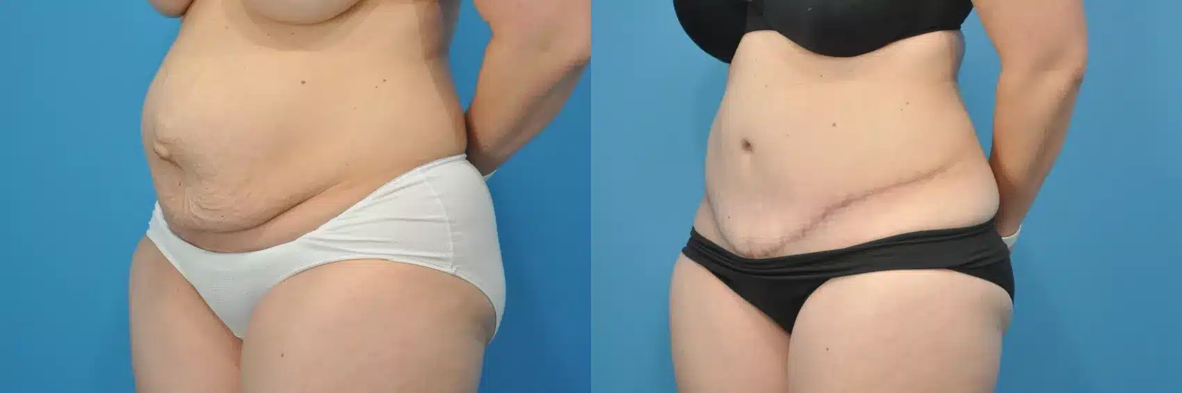 Before and After Image: Case #156 - left-front-oblique