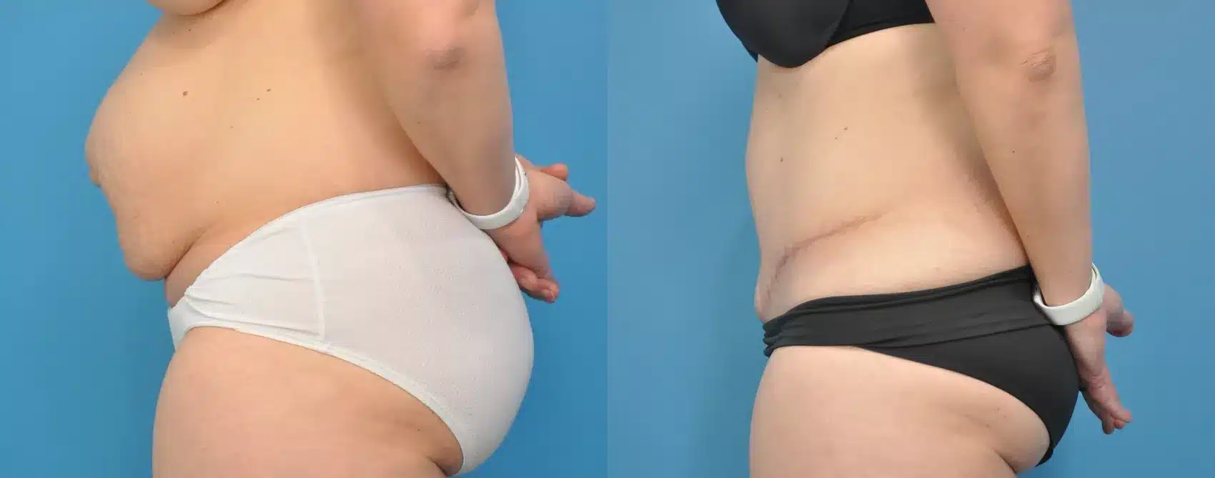Before and After Image: Case #156 - left-side
