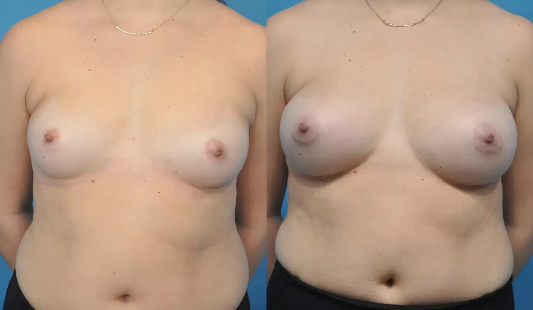 Before and After Image: Case #158 - front