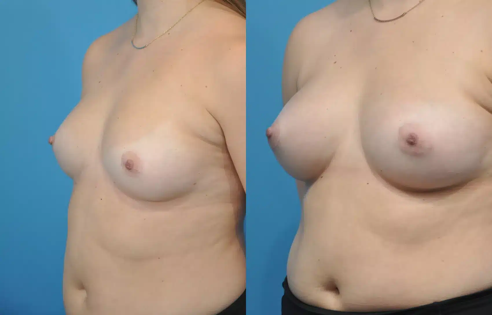 Before and After Image: Case #158 - left-front-oblique