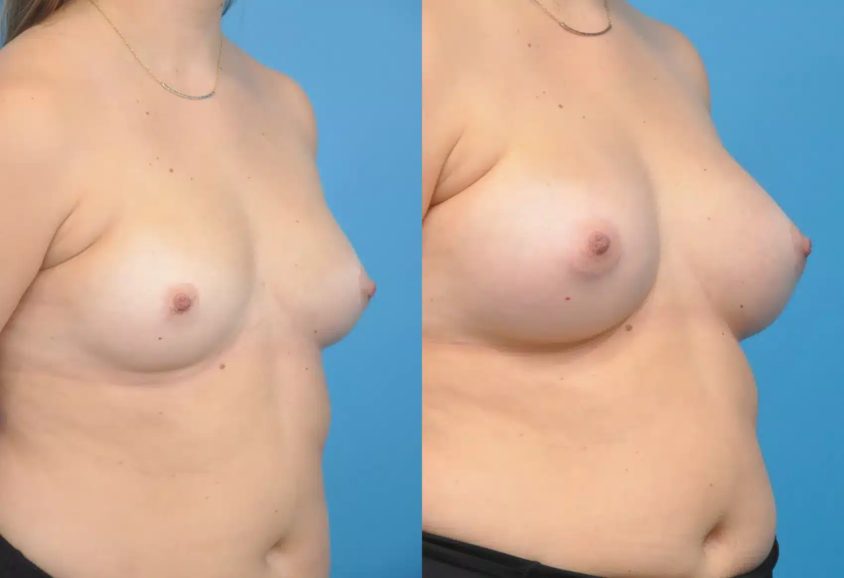 Before and After Image: Case #158 - right-front-oblique