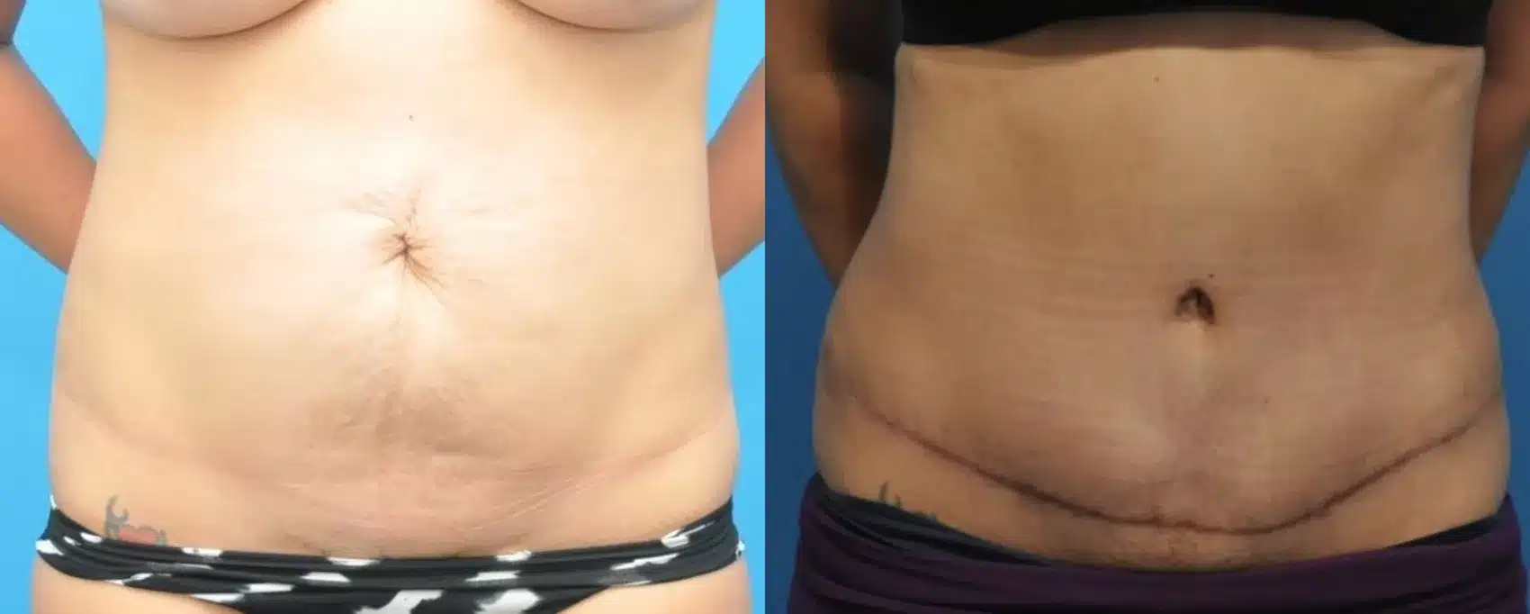 Before and After Image: Case #159 - front
