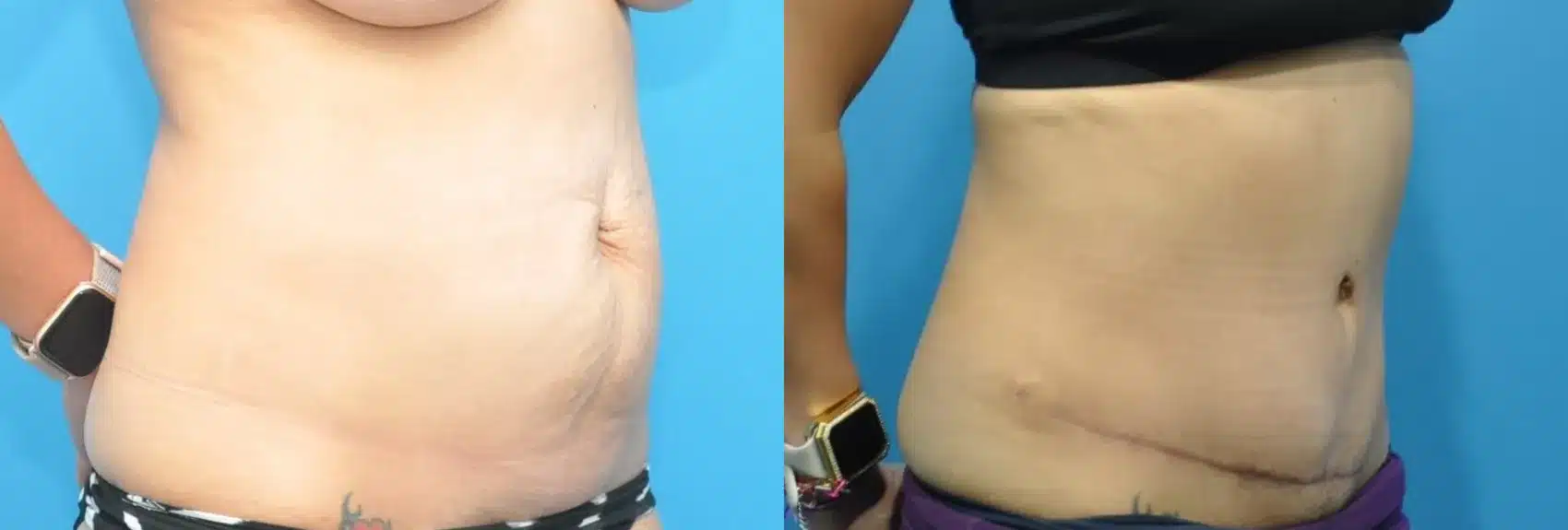 Before and After Image: Case #159 - right-front-oblique