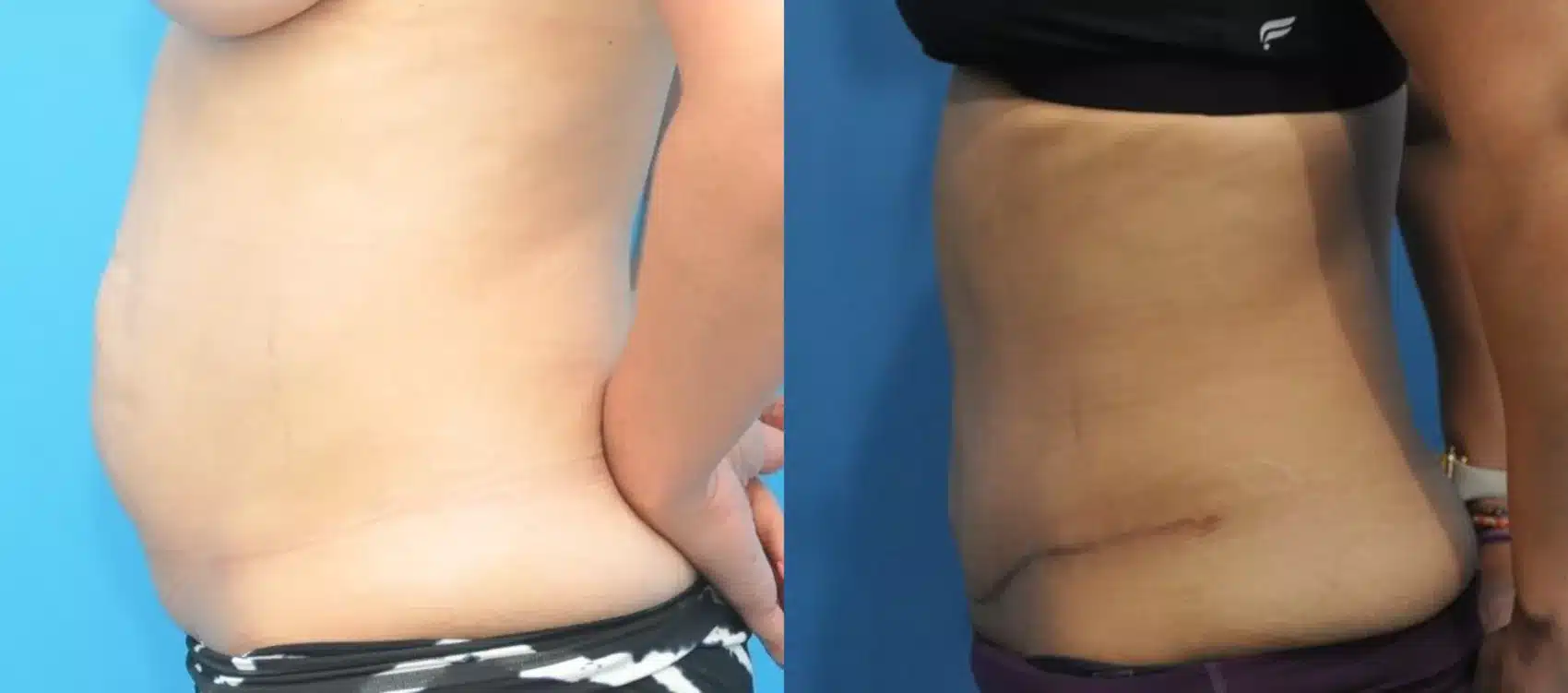 Before and After Image: Case #159 - left-side