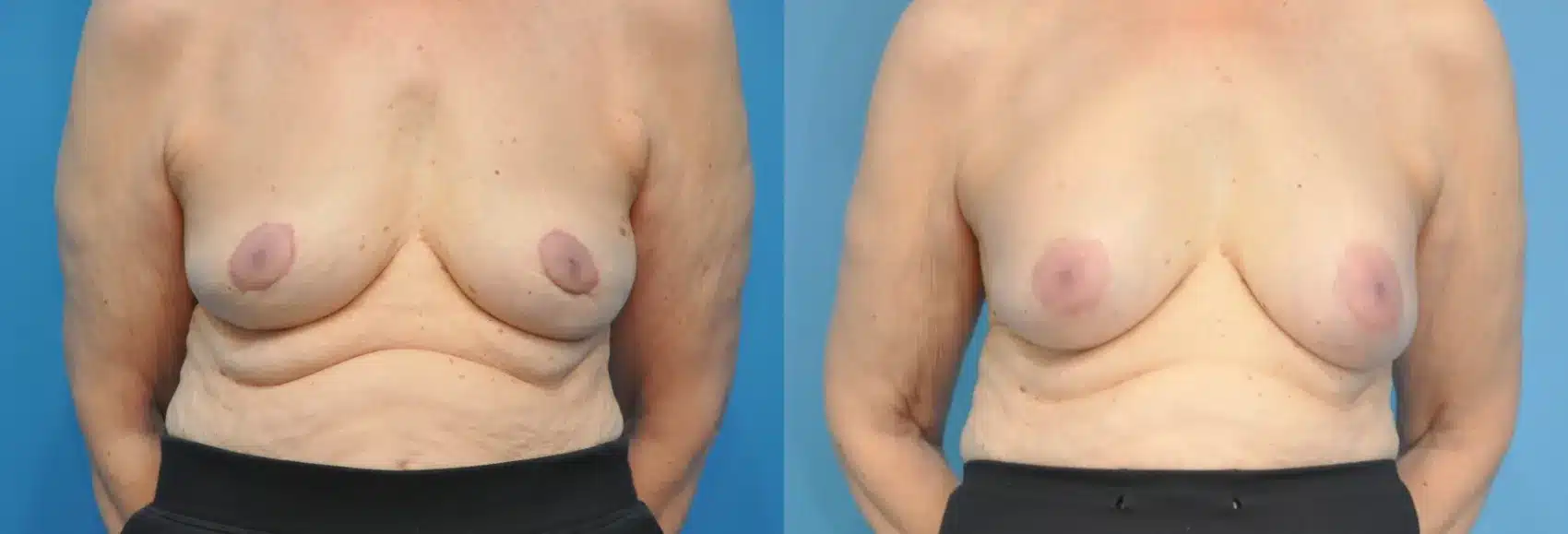 Before and After Image: Breast Implant Removal with Nipple Lift - front