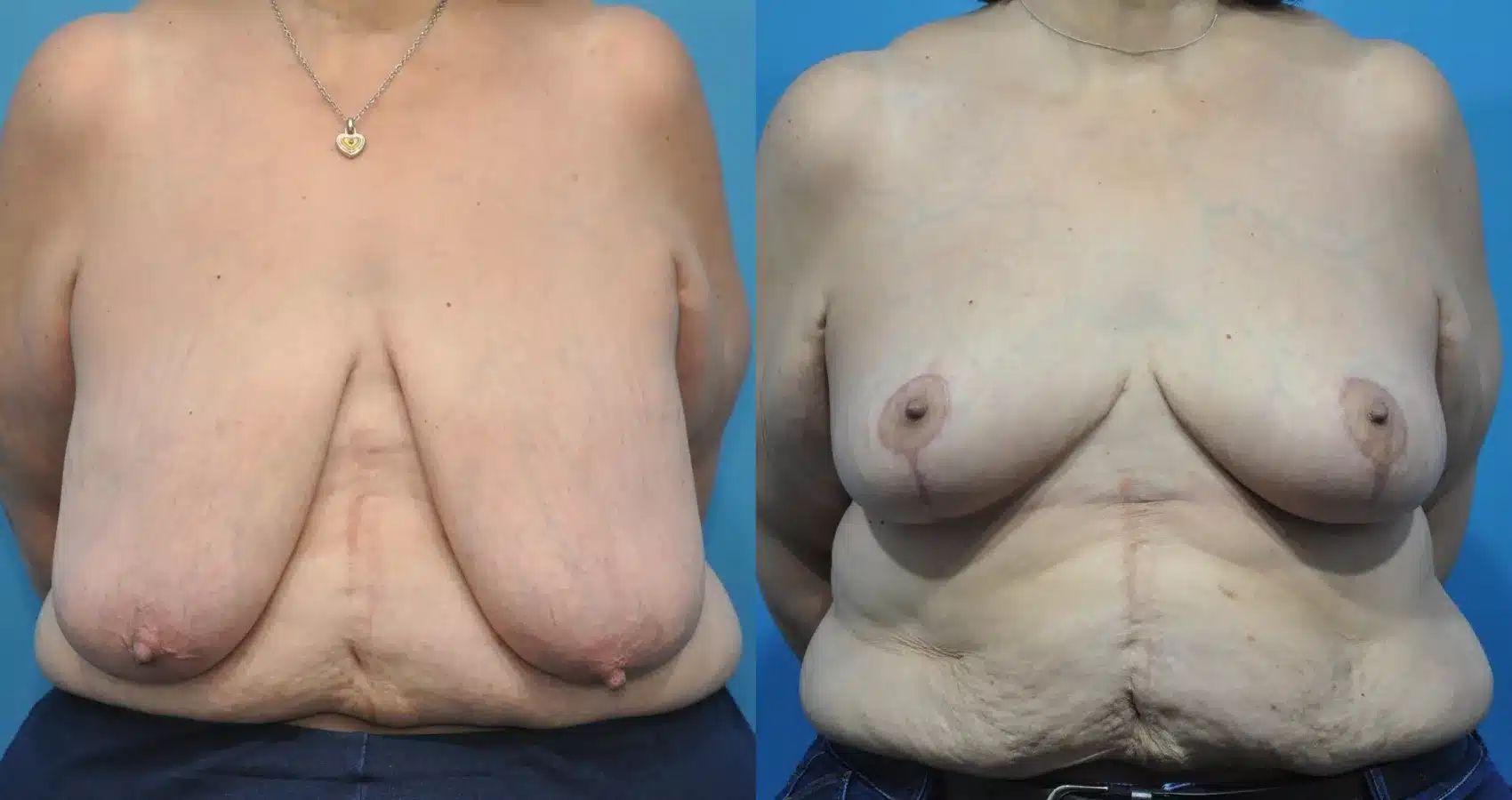 Before and After Image: Case #163 - front