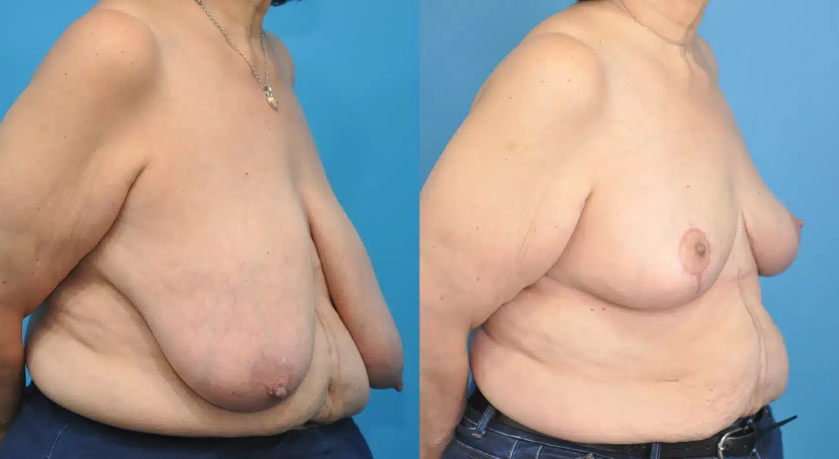 Before and After Image: Case #163 - right-front-oblique