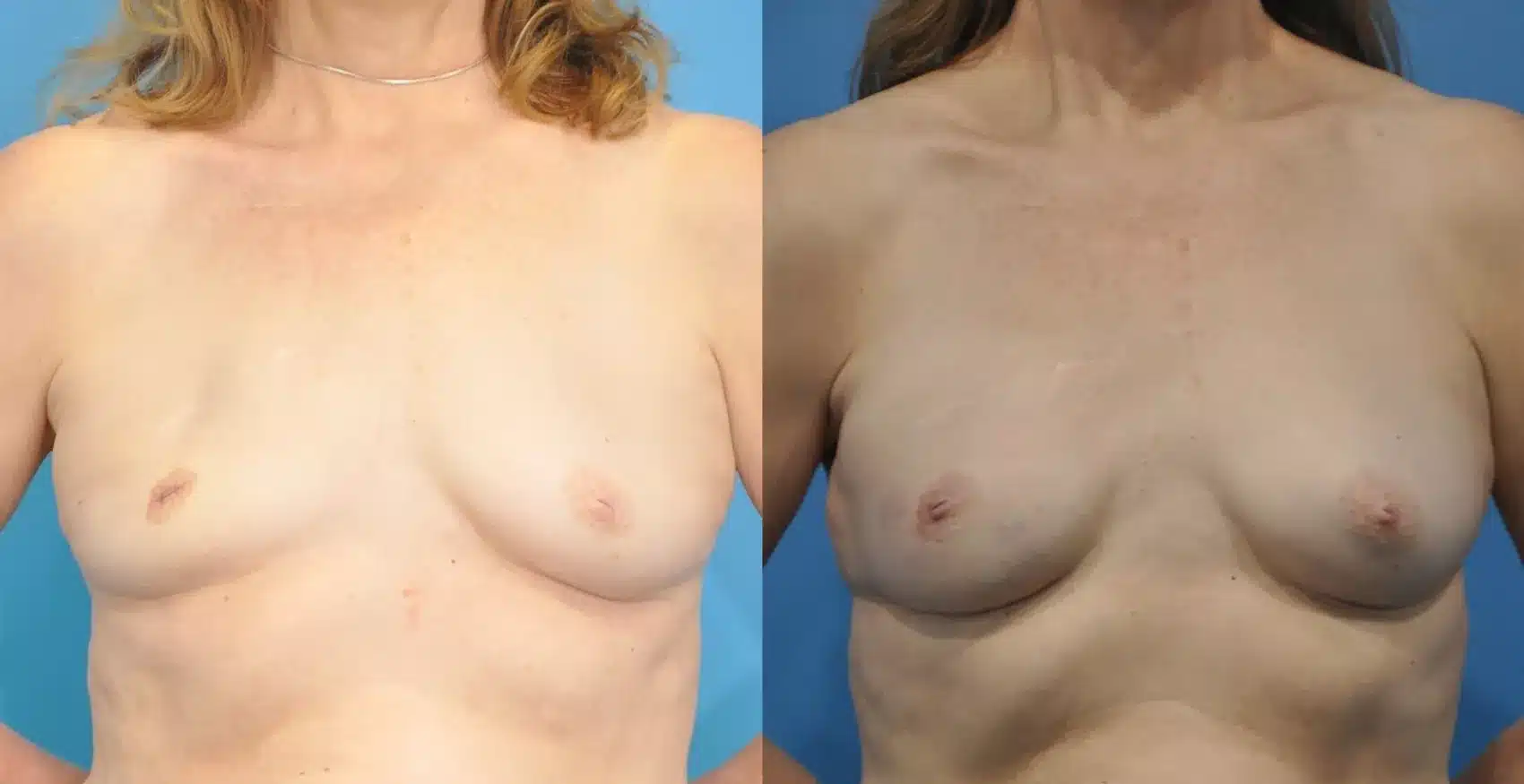 Before and After Image: Case #165 - front