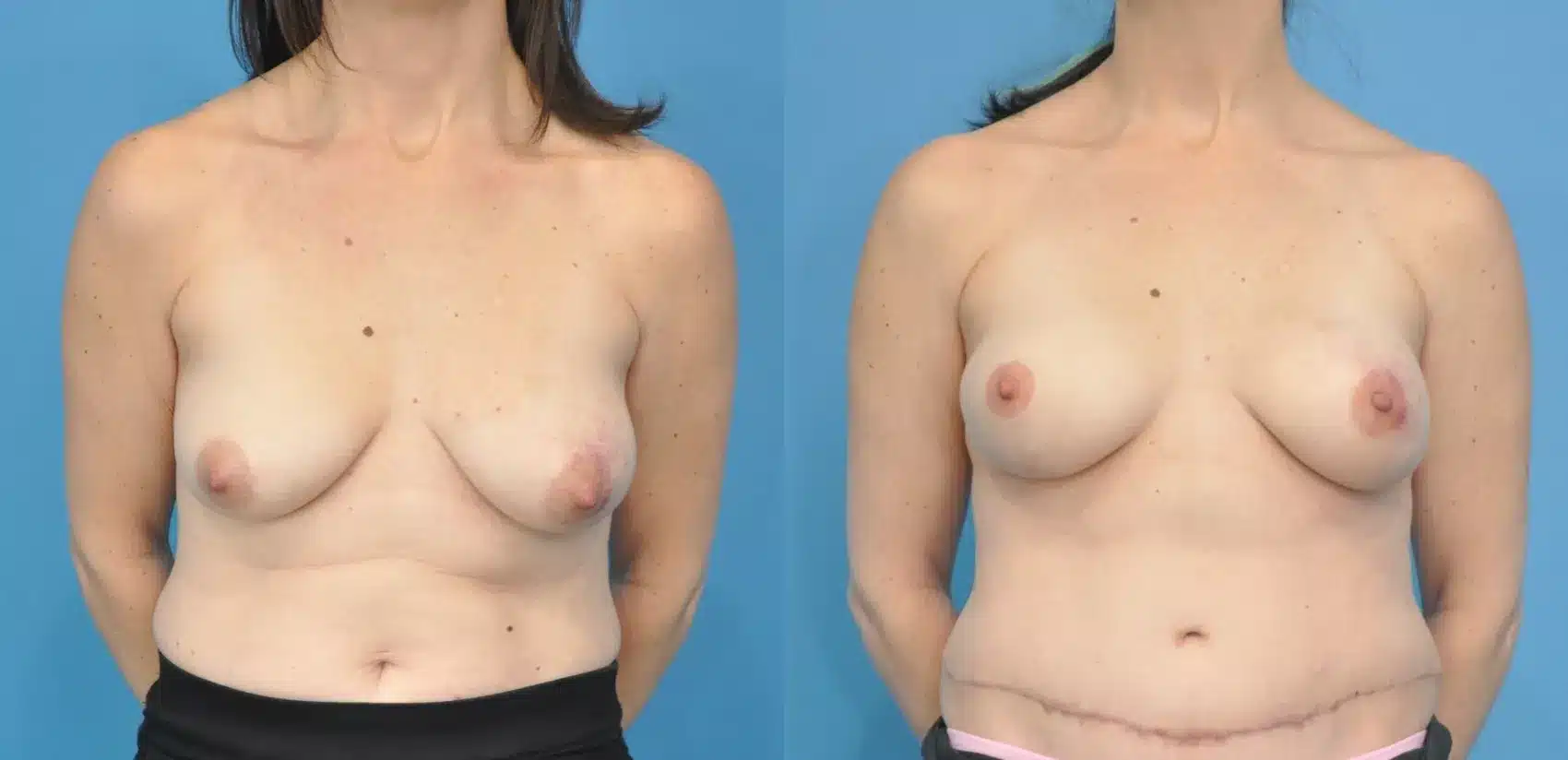 Before and After Image: Case #166 - front
