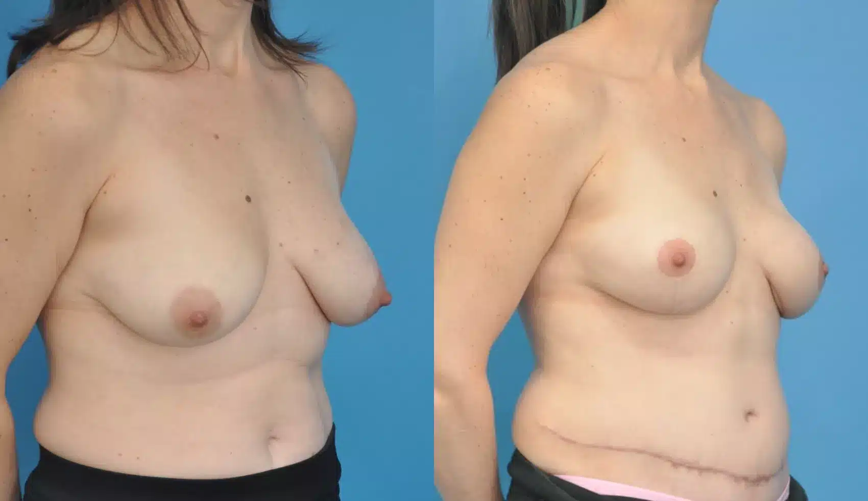 Before and After Image: Case #166 - right-front-oblique