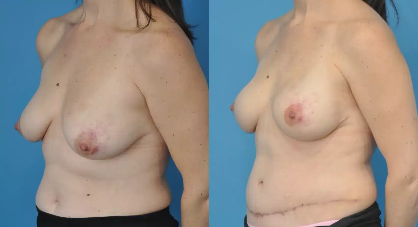 Before and After Image: Case #166 - left-front-oblique